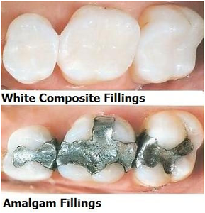 Amalgam vs. Composite Fillings: What’s the Best Option for You