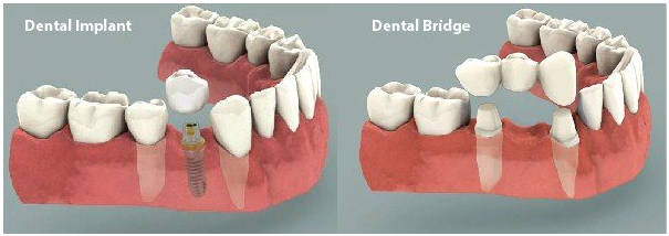 Dental Implants vs. Dental Bridges: Understanding the Pros and Cons