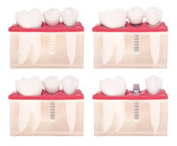 dental implants