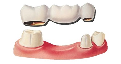 porcelain veneer bridge
