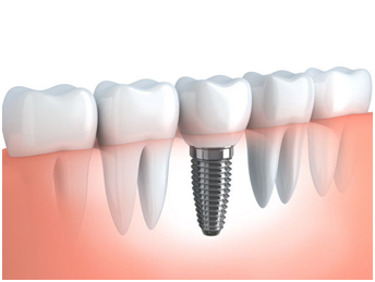 Dental Implants Help You Smile with Confidence