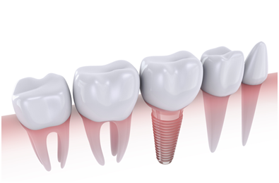 Dental Implants in Los Angeles