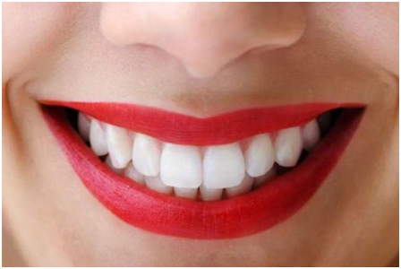 Teeth Whitening