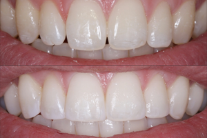 cosmetic bonding cosmetic bonding