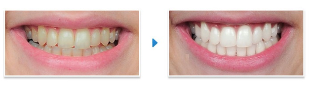 Three Benefits of Professional Teeth Whitening