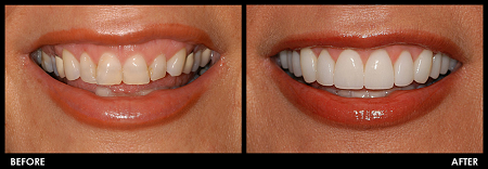 dental veneers