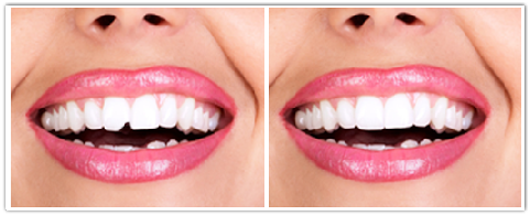 Cosmetic Tooth Bonding