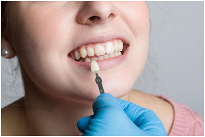 dental veneers in los angeles