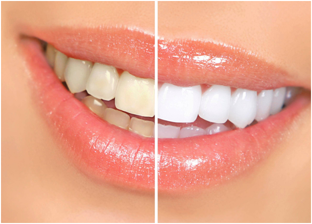 Tooth Stain – Top Sources Revealed