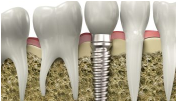 Dental Implants in Los Angeles