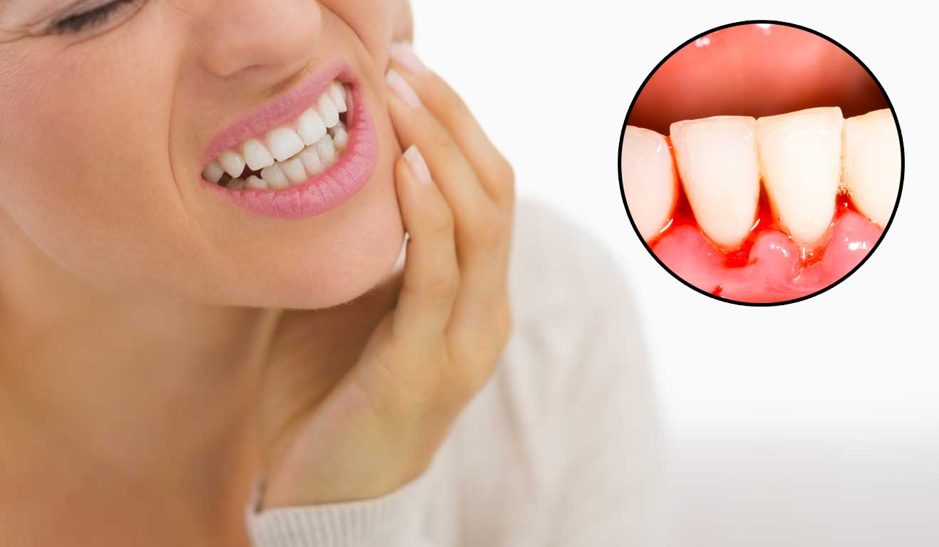 Bleeding gums